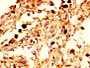 IHC image diluted at 1:300 and staining in paraffin-embedded human melanoma performed on a Leica BondTM system. After dewaxing and hydration, antigen retrieval was mediated by high pressure in a citrate buffer (pH 6.0). Section was blocked with 10% normal goat serum 30min at RT. Then primary antibody (1% BSA) was incubated at 4°C overnight. The primary is detected by a biotinylated secondary antibody and visualized using an HRP conjugated SP system.