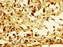 IHC image diluted at 1:300 and staining in paraffin-embedded human melanoma performed on a Leica BondTM system. After dewaxing and hydration, antigen retrieval was mediated by high pressure in a citrate buffer (pH 6.0). Section was blocked with 10% normal goat serum 30min at RT. Then primary antibody (1% BSA) was incubated at 4°C overnight. The primary is detected by a biotinylated secondary antibody and visualized using an HRP conjugated SP system.