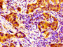 IHC image diluted at 1:100 and staining in paraffin-embedded human pancreatic cancer performed on a Leica BondTM system. After dewaxing and hydration, antigen retrieval was mediated by high pressure in a citrate buffer (pH 6.0). Section was blocked with 10% normal goat serum 30min at RT. Then primary antibody (1% BSA) was incubated at 4°C overnight. The primary is detected by a biotinylated secondary antibody and visualized using an HRP conjugated SP system.