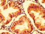 IHC image diluted at 1:300 and staining in paraffin-embedded human endometrial cancer performed on a Leica BondTM system. After dewaxing and hydration, antigen retrieval was mediated by high pressure in a citrate buffer (pH 6.0). Section was blocked with 10% normal goat serum 30min at RT. Then primary antibody (1% BSA) was incubated at 4°C overnight. The primary is detected by a biotinylated secondary antibody and visualized using an HRP conjugated SP system.