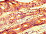 IHC image diluted at 1:500 and staining in paraffin-embedded human colon cancer performed on a Leica BondTM system. After dewaxing and hydration, antigen retrieval was mediated by high pressure in a citrate buffer (pH 6.0). Section was blocked with 10% normal goat serum 30min at RT. Then primary antibody (1% BSA) was incubated at 4°C overnight. The primary is detected by a biotinylated secondary antibody and visualized using an HRP conjugated SP system.