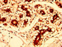 IHC image diluted at 1:300 and staining in paraffin-embedded human breast cancer performed on a Leica BondTM system. After dewaxing and hydration, antigen retrieval was mediated by high pressure in a citrate buffer (pH 6.0). Section was blocked with 10% normal goat serum 30min at RT. Then primary antibody (1% BSA) was incubated at 4°C overnight. The primary is detected by a biotinylated secondary antibody and visualized using an HRP conjugated SP system.
