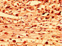 IHC image diluted at 1:300 and staining in paraffin-embedded human melanoma performed on a Leica BondTM system. After dewaxing and hydration, antigen retrieval was mediated by high pressure in a citrate buffer (pH 6.0). Section was blocked with 10% normal goat serum 30min at RT. Then primary antibody (1% BSA) was incubated at 4°C overnight. The primary is detected by a biotinylated secondary antibody and visualized using an HRP conjugated SP system.