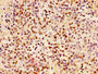 Immunohistochemistry of paraffin-embedded human colon cancer using CAC11297 at dilution of 1:100