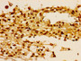 Immunohistochemistry of paraffin-embedded human melanoma using CAC11298 at dilution of 1:100