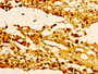 Immunohistochemistry of paraffin-embedded human melanoma using CAC11299 at dilution of 1:100