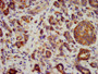 IHC image diluted at 1:400 and staining in paraffin-embedded human pancreatic cancer performed on a Leica BondTM system. After dewaxing and hydration, antigen retrieval was mediated by high pressure in a citrate buffer (pH 6.0). Section was blocked with 10% normal goat serum 30min at RT. Then primary antibody (1% BSA) was incubated at 4°C overnight. The primary is detected by a biotinylated secondary antibody and visualized using an HRP conjugated SP system.