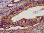 IHC image diluted at 1:400 and staining in paraffin-embedded human colon cancer performed on a Leica BondTM system. After dewaxing and hydration, antigen retrieval was mediated by high pressure in a citrate buffer (pH 6.0). Section was blocked with 10% normal goat serum 30min at RT. Then primary antibody (1% BSA) was incubated at 4°C overnight. The primary is detected by a biotinylated secondary antibody and visualized using an HRP conjugated SP system.