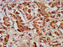 IHC image diluted at 1:200 and staining in paraffin-embedded human liver cancer performed on a Leica BondTM system. After dewaxing and hydration, antigen retrieval was mediated by high pressure in a citrate buffer (pH 6.0). Section was blocked with 10% normal goat serum 30min at RT. Then primary antibody (1% BSA) was incubated at 4°C overnight. The primary is detected by a biotinylated secondary antibody and visualized using an HRP conjugated SP system.