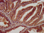 IHC image diluted at 1:300 and staining in paraffin-embedded human prostate tissue performed on a Leica BondTM system. After dewaxing and hydration, antigen retrieval was mediated by high pressure in a citrate buffer (pH 6.0). Section was blocked with 10% normal goat serum 30min at RT. Then primary antibody (1% BSA) was incubated at 4°C overnight. The primary is detected by a biotinylated secondary antibody and visualized using an HRP conjugated SP system.