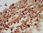 IHC image diluted at 1:300 and staining in paraffin-embedded human melanoma performed on a Leica BondTM system. After dewaxing and hydration, antigen retrieval was mediated by high pressure in a citrate buffer (pH 6.0). Section was blocked with 10% normal goat serum 30min at RT. Then primary antibody (1% BSA) was incubated at 4°C overnight. The primary is detected by a biotinylated secondary antibody and visualized using an HRP conjugated SP system.