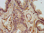 IHC image diluted at 1:500 and staining in paraffin-embedded human prostate cancer performed on a Leica BondTM system. After dewaxing and hydration, antigen retrieval was mediated by high pressure in a citrate buffer (pH 6.0). Section was blocked with 10% normal goat serum 30min at RT. Then primary antibody (1% BSA) was incubated at 4°C overnight. The primary is detected by a biotinylated secondary antibody and visualized using an HRP conjugated SP system.