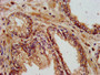 IHC image of CAC11356 diluted at 1:400 and staining in paraffin-embedded human prostate cancer performed on a Leica BondTM system.