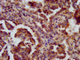 IHC image of CAC11359 diluted at 1:600 and staining in paraffin-embedded human lung cancer performed on a Leica BondTM system. After dewaxing and hydration, antigen retrieval was mediated by high pressure in a citrate buffer (pH 6.0). Section was blocked with 10% normal goat serum 30min at RT. Then primary antibody (1% BSA) was incubated at 4°C overnight. The primary is detected by a biotinylated secondary antibody and visualized using an HRP conjugated SP system.