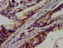 IHC image diluted at 1:600 and staining in paraffin-embedded human colon cancer performed on a Leica BondTM system. After dewaxing and hydration, antigen retrieval was mediated by high pressure in a citrate buffer (pH 6.0). Section was blocked with 10% normal goat serum 30min at RT. Then primary antibody (1% BSA) was incubated at 4°C overnight. The primary is detected by a biotinylated secondary antibody and visualized using an HRP conjugated SP system.