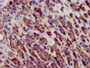 IHC image diluted at 1:600 and staining in paraffin-embedded human pancreatic cancer performed on a Leica BondTM system. After dewaxing and hydration, antigen retrieval was mediated by high pressure in a citrate buffer (pH 6.0). Section was blocked with 10% normal goat serum 30min at RT. Then primary antibody (1% BSA) was incubated at 4°C overnight. The primary is detected by a biotinylated secondary antibody and visualized using an HRP conjugated SP system.