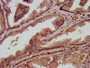IHC image diluted at 1:800 and staining in paraffin-embedded human prostate tissue performed on a Leica BondTM system. After dewaxing and hydration, antigen retrieval was mediated by high pressure in a citrate buffer (pH 6.0). Section was blocked with 10% normal goat serum 30min at RT. Then primary antibody (1% BSA) was incubated at 4°C overnight. The primary is detected by a biotinylated secondary antibody and visualized using an HRP conjugated SP system.