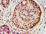 IHC image diluted at 1:500 and staining in paraffin-embedded human pancreatic cancer performed on a Leica BondTM system. After dewaxing and hydration, antigen retrieval was mediated by high pressure in a citrate buffer (pH 6.0). Section was blocked with 10% normal goat serum 30min at RT. Then primary antibody (1% BSA) was incubated at 4°C overnight. The primary is detected by a biotinylated secondary antibody and visualized using an HRP conjugated SP system.
