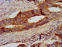 IHC image of CAC11370 diluted at 1:300 and staining in paraffin-embedded human colon cancer performed on a Leica BondTM system. After dewaxing and hydration, antigen retrieval was mediated by high pressure in a citrate buffer (pH 6.0). Section was blocked with 10% normal goat serum 30min at RT. Then primary antibody (1% BSA) was incubated at 4°C overnight. The primary is detected by a biotinylated secondary antibody and visualized using an HRP conjugated SP system.