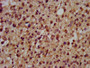 IHC image of CAC11372 diluted at 1:200 and staining in paraffin-embedded human glioma performed on a Leica BondTM system. After dewaxing and hydration, antigen retrieval was mediated by high pressure in a citrate buffer (pH 6.0). Section was blocked with 10% normal goat serum 30min at RT. Then primary antibody (1% BSA) was incubated at 4°C overnight. The primary is detected by a biotinylated secondary antibody and visualized using an HRP conjugated SP system.