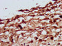 IHC image diluted at 1:500 and staining in paraffin-embedded human melanoma performed on a Leica BondTM system. After dewaxing and hydration, antigen retrieval was mediated by high pressure in a citrate buffer (pH 6.0). Section was blocked with 10% normal goat serum 30min at RT. Then primary antibody (1% BSA) was incubated at 4°C overnight. The primary is detected by a biotinylated secondary antibody and visualized using an HRP conjugated SP system.