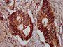 IHC image of CAC11391 diluted at 1:300 and staining in paraffin-embedded human colon cancer performed on a Leica BondTM system. After dewaxing and hydration, antigen retrieval was mediated by high pressure in a citrate buffer (pH 6.0). Section was blocked with 10% normal goat serum 30min at RT. Then primary antibody (1% BSA) was incubated at 4°C overnight. The primary is detected by a biotinylated secondary antibody and visualized using an HRP conjugated SP system.