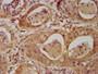 IHC image of CAC11392 diluted at 1:500 and staining in paraffin-embedded human cervical cancer performed on a Leica BondTM system. After dewaxing and hydration, antigen retrieval was mediated by high pressure in a citrate buffer (pH 6.0). Section was blocked with 10% normal goat serum 30min at RT. Then primary antibody (1% BSA) was incubated at 4°C overnight. The primary is detected by a biotinylated secondary antibody and visualized using an HRP conjugated SP system.