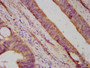 IHC image diluted at 1:500 and staining in paraffin-embedded human colon cancer performed on a Leica BondTM system. After dewaxing and hydration, antigen retrieval was mediated by high pressure in a citrate buffer (pH 6.0). Section was blocked with 10% normal goat serum 30min at RT. Then primary antibody (1% BSA) was incubated at 4°C overnight. The primary is detected by a biotinylated secondary antibody and visualized using an HRP conjugated SP system.