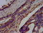 IHC image diluted at 1:300 and staining in paraffin-embedded human colon cancer performed on a Leica BondTM system. After dewaxing and hydration, antigen retrieval was mediated by high pressure in a citrate buffer (pH 6.0). Section was blocked with 10% normal goat serum 30min at RT. Then primary antibody (1% BSA) was incubated at 4°C overnight. The primary is detected by a biotinylated secondary antibody and visualized using an HRP conjugated SP system.