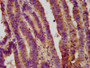 IHC image of CAC11421 diluted at 1:800 and staining in paraffin-embedded human colon cancer performed on a Leica BondTM system. After dewaxing and hydration, antigen retrieval was mediated by high pressure in a citrate buffer (pH 6.0). Section was blocked with 10% normal goat serum 30min at RT. Then primary antibody (1% BSA) was incubated at 4°C overnight. The primary is detected by a biotinylated secondary antibody and visualized using an HRP conjugated SP system.