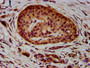 IHC image diluted at 1:400 and staining in paraffin-embedded human pancreatic cancer performed on a Leica BondTM system. After dewaxing and hydration, antigen retrieval was mediated by high pressure in a citrate buffer (pH 6.0). Section was blocked with 10% normal goat serum 30min at RT. Then primary antibody (1% BSA) was incubated at 4°C overnight. The primary is detected by a biotinylated secondary antibody and visualized using an HRP conjugated SP system.