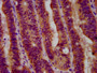 IHC image diluted at 1:600 and staining in paraffin-embedded human colon cancer performed on a Leica BondTM system. After dewaxing and hydration, antigen retrieval was mediated by high pressure in a citrate buffer (pH 6.0). Section was blocked with 10% normal goat serum 30min at RT. Then primary antibody (1% BSA) was incubated at 4°C overnight. The primary is detected by a biotinylated secondary antibody and visualized using an HRP conjugated SP system.