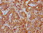 IHC image diluted at 1:400 and staining in paraffin-embedded human liver cancer performed on a Leica BondTM system. After dewaxing and hydration, antigen retrieval was mediated by high pressure in a citrate buffer (pH 6.0). Section was blocked with 10% normal goat serum 30min at RT. Then primary antibody (1% BSA) was incubated at 4°C overnight. The primary is detected by a biotinylated secondary antibody and visualized using an HRP conjugated SP system.