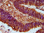 IHC image diluted at 1:300 and staining in paraffin-embedded human ovarian cancer performed on a Leica BondTM system. After dewaxing and hydration, antigen retrieval was mediated by high pressure in a citrate buffer (pH 6.0). Section was blocked with 10% normal goat serum 30min at RT. Then primary antibody (1% BSA) was incubated at 4°C overnight. The primary is detected by a biotinylated secondary antibody and visualized using an HRP conjugated SP system.