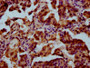 IHC image diluted at 1:300 and staining in paraffin-embedded human lung cancer performed on a Leica BondTM system. After dewaxing and hydration, antigen retrieval was mediated by high pressure in a citrate buffer (pH 6.0). Section was blocked with 10% normal goat serum 30min at RT. Then primary antibody (1% BSA) was incubated at 4°C overnight. The primary is detected by a biotinylated secondary antibody and visualized using an HRP conjugated SP system.