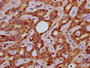 IHC image of CAC11463 diluted at 1:200 and staining in paraffin-embedded human liver cancer performed on a Leica BondTM system. After dewaxing and hydration, antigen retrieval was mediated by high pressure in a citrate buffer (pH 6.0). Section was blocked with 10% normal goat serum 30min at RT. Then primary antibody (1% BSA) was incubated at 4°C overnight. The primary is detected by a biotinylated secondary antibody and visualized using an HRP conjugated SP system.