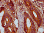 IHC image diluted at 1:400 and staining in paraffin-embedded human colon cancer performed on a Leica BondTM system. After dewaxing and hydration, antigen retrieval was mediated by high pressure in a citrate buffer (pH 6.0). Section was blocked with 10% normal goat serum 30min at RT. Then primary antibody (1% BSA) was incubated at 4°C overnight. The primary is detected by a biotinylated secondary antibody and visualized using an HRP conjugated SP system.