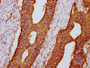 IHC image of CAC11496 diluted at 1:600 and staining in paraffin-embedded human colon cancer performed on a Leica BondTM system. After dewaxing and hydration, antigen retrieval was mediated by high pressure in a citrate buffer (pH 6.0). Section was blocked with 10% normal goat serum 30min at RT. Then primary antibody (1% BSA) was incubated at 4°C overnight. The primary is detected by a biotinylated secondary antibody and visualized using an HRP conjugated SP system.