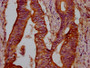 IHC image diluted at 1:300 and staining in paraffin-embedded human colon cancer performed on a Leica BondTM system. After dewaxing and hydration, antigen retrieval was mediated by high pressure in a citrate buffer (pH 6.0). Section was blocked with 10% normal goat serum 30min at RT. Then primary antibody (1% BSA) was incubated at 4°C overnight. The primary is detected by a biotinylated secondary antibody and visualized using an HRP conjugated SP system.