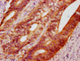 IHC image of CAC11514 diluted at 1:400 and staining in paraffin-embedded human colon cancer performed on a Leica BondTM system. After dewaxing and hydration, antigen retrieval was mediated by high pressure in a citrate buffer (pH 6.0). Section was blocked with 10% normal goat serum 30min at RT. Then primary antibody (1% BSA) was incubated at 4°C overnight. The primary is detected by a biotinylated secondary antibody and visualized using an HRP conjugated SP system.