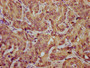 IHC image diluted at 1:800 and staining in paraffin-embedded human liver cancer performed on a Leica BondTM system. After dewaxing and hydration, antigen retrieval was mediated by high pressure in a citrate buffer (pH 6.0). Section was blocked with 10% normal goat serum 30min at RT. Then primary antibody (1% BSA) was incubated at 4°C overnight. The primary is detected by a biotinylated secondary antibody and visualized using an HRP conjugated SP system.