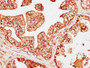 IHC image of CAC11552 diluted at 1:200 and staining in paraffin-embedded human prostate cancer performed on a Leica BondTM system. After dewaxing and hydration, antigen retrieval was mediated by high pressure in a citrate buffer (pH 6.0). Section was blocked with 10% normal goat serum 30min at RT. Then primary antibody (1% BSA) was incubated at 4°C overnight. The primary is detected by a biotinylated secondary antibody and visualized using an HRP conjugated SP system.