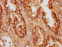 IHC image diluted at 1:500 and staining in paraffin-embedded human prostate cancer performed on a Leica BondTM system. After dewaxing and hydration, antigen retrieval was mediated by high pressure in a citrate buffer (pH 6.0). Section was blocked with 10% normal goat serum 30min at RT. Then primary antibody (1% BSA) was incubated at 4°C overnight. The primary is detected by a biotinylated secondary antibody and visualized using an HRP conjugated SP system.