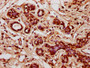 IHC image diluted at 1:400 and staining in paraffin-embedded human breast cancer performed on a Leica BondTM system. After dewaxing and hydration, antigen retrieval was mediated by high pressure in a citrate buffer (pH 6.0). Section was blocked with 10% normal goat serum 30min at RT. Then primary antibody (1% BSA) was incubated at 4°C overnight. The primary is detected by a biotinylated secondary antibody and visualized using an HRP conjugated SP system.