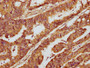 IHC image of CAC11581 diluted at 1:300 and staining in paraffin-embedded human colon cancer performed on a Leica BondTM system. After dewaxing and hydration, antigen retrieval was mediated by high pressure in a citrate buffer(pH 6.0). Section was blocked with 10% normal goat serum 30min at RT. Then primary antibody(1% BSA) was incubated at 4°C overnight. The primary is detected by a biotinylated secondary antibody and visualized using an HRP conjugated SP system.