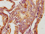 IHC image diluted at 1:100 and staining in paraffin-embedded human endometrial cancer performed on a Leica BondTM system. After dewaxing and hydration, antigen retrieval was mediated by high pressure in a citrate buffer (pH 6.0). Section was blocked with 10% normal goat serum 30min at RT. Then primary antibody (1% BSA) was incubated at 4°C overnight. The primary is detected by a biotinylated secondary antibody and visualized using an HRP conjugated SP system.