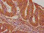 IHC image diluted at 1:640 and staining in paraffin-embedded human colon cancer performed on a Leica BondTM system. After dewaxing and hydration, antigen retrieval was mediated by high pressure in a citrate buffer (pH 6.0). Section was blocked with 10% normal goat serum 30min at RT. Then primary antibody (1% BSA) was incubated at 4°C overnight. The primary is detected by a biotinylated secondary antibody and visualized using an HRP conjugated SP system.