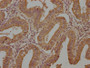 IHC image diluted at 1:1500 and staining in paraffin-embedded human endometrial cancer performed on a Leica BondTM system. After dewaxing and hydration, antigen retrieval was mediated by high pressure in a citrate buffer (pH 6.0). Section was blocked with 10% normal goat serum 30min at RT. Then primary antibody (1% BSA) was incubated at 4°C overnight. The primary is detected by a biotinylated secondary antibody and visualized using an HRP conjugated SP system.
