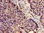 Immunohistochemistry analysis of human ovarian cancer using CAC11722 at dilution of 1:100