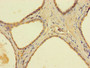 Immunohistochemistry of paraffin-embedded human prostate cancer using CAC11725 at dilution of 1:100